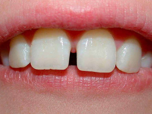 диастема между передними зубами