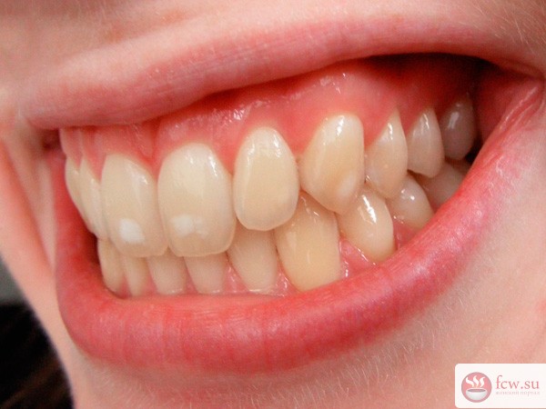 Гиперплазия зубной эмали: как быть?