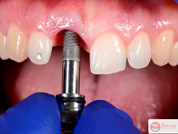 Мифы и факты об имплантации зубов
